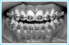 tratamento ortodôntico com aparelho fixo