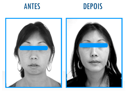 Caso 1 de Cirurgia Ortognática - Frontal