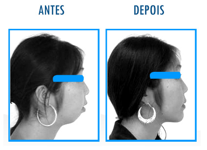 Caso 1 de Cirurgia Ortognática - Perfil