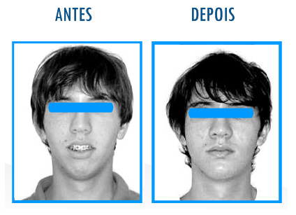 Caso 2 de Cirurgia Ortognática - Frontal