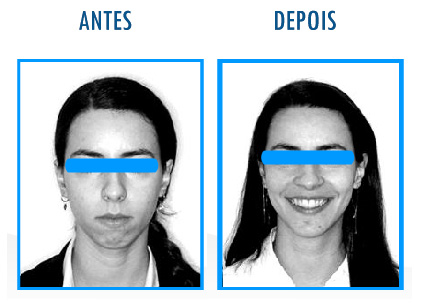 Caso 4 de Cirurgia Ortognática - Frontal