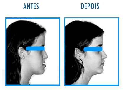 Caso 5 de Cirurgia Ortognática - Perfil