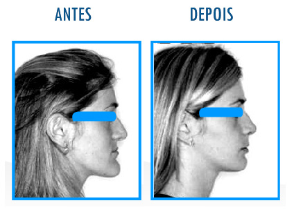 Caso 6 de Cirurgia Ortognática - Perfil