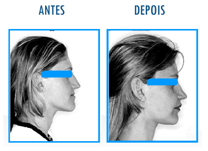 Caso 7 de Cirurgia Ortognática - Perfil