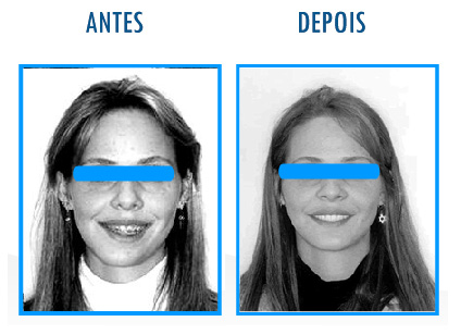 Caso 8 de Cirurgia Ortognática - Frontal