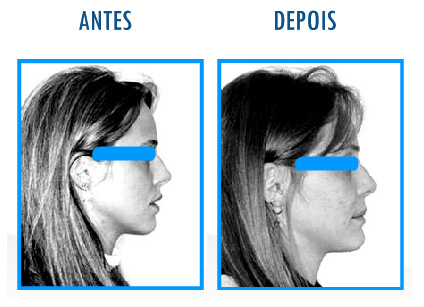 Caso 8 de Cirurgia Ortognática - Perfil