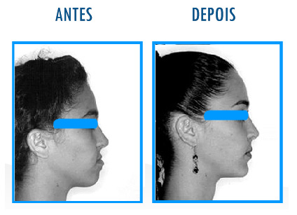 Caso 9 de Cirurgia Ortognática - Perfil